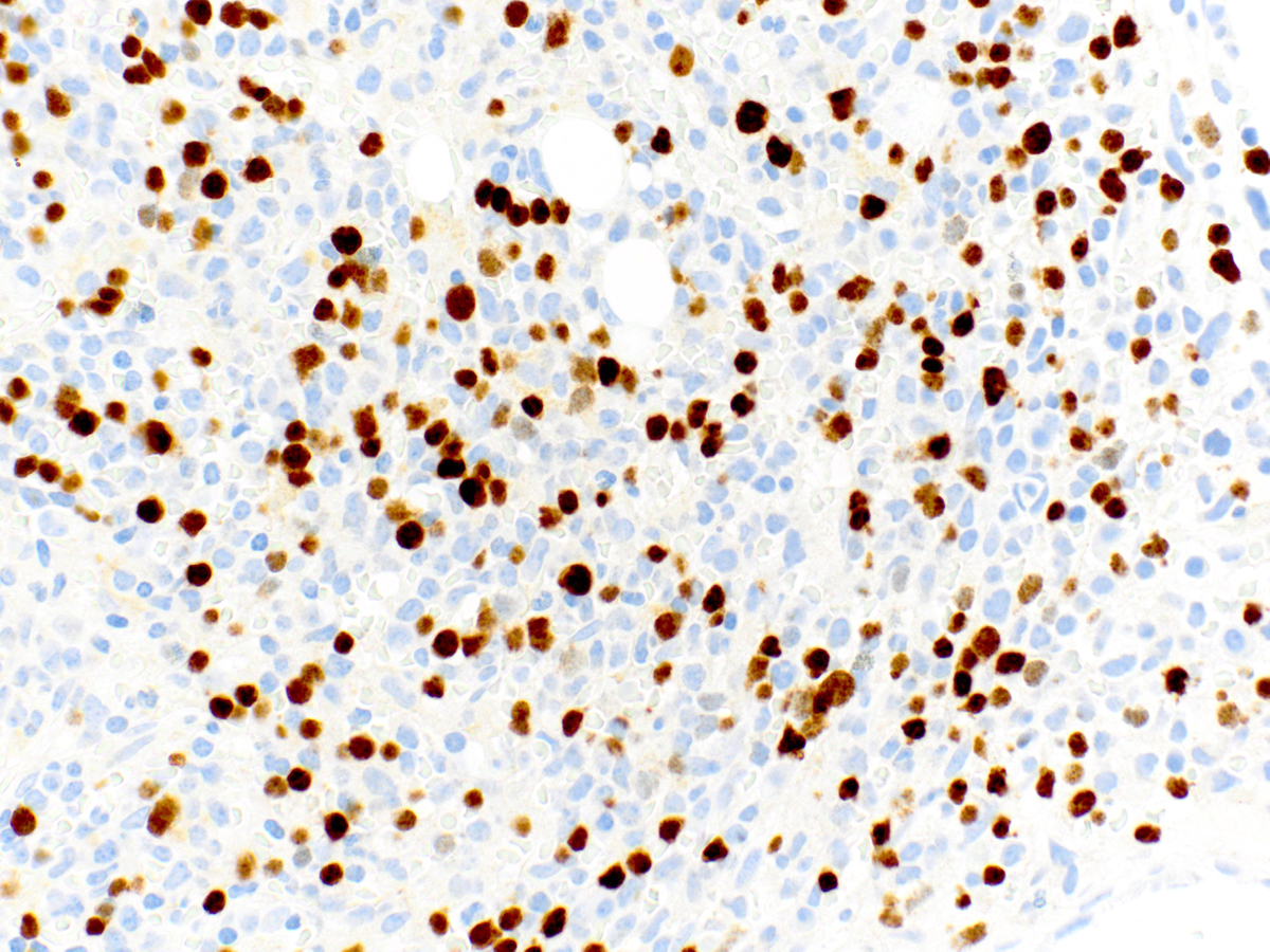 TdT staining of subset of blasts (40x).